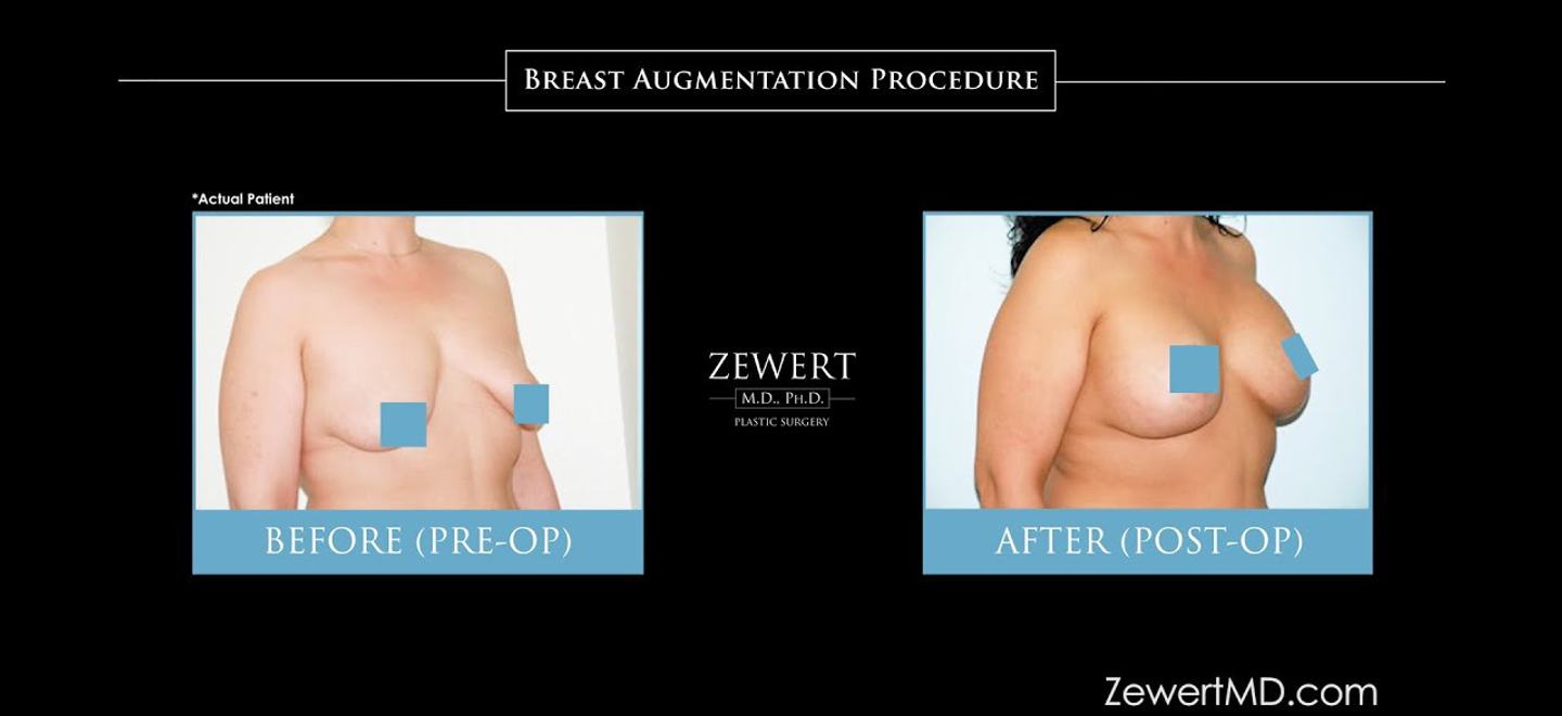 Breast Augmentation
