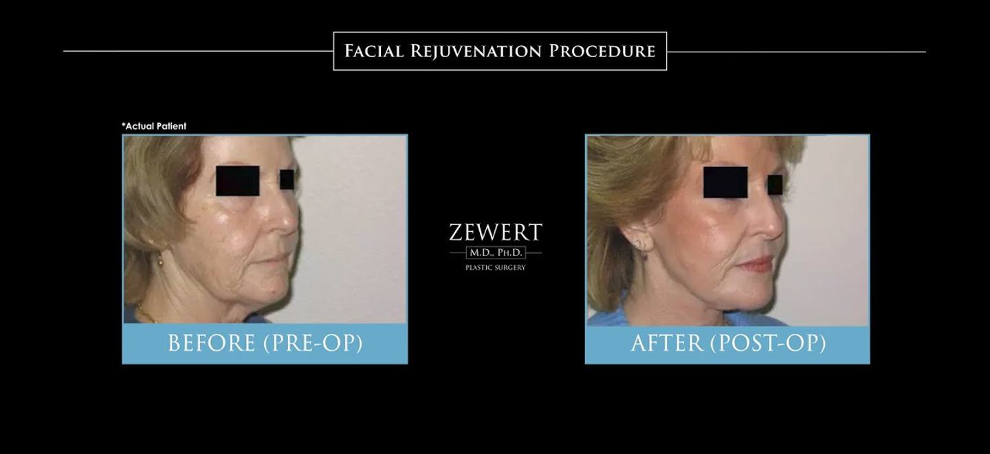 Facial Rejuvenation