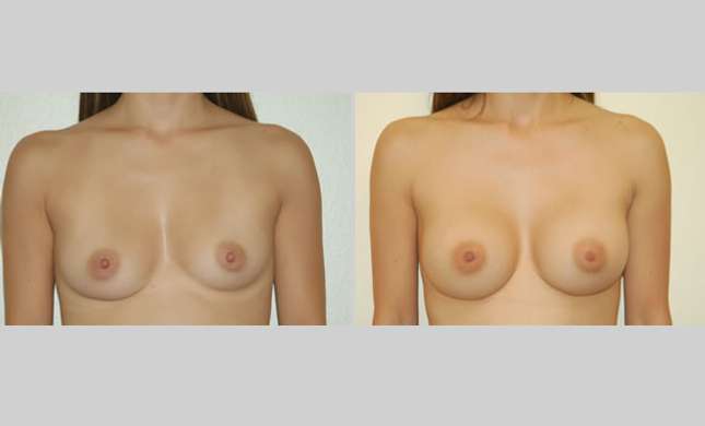 Breast Augmentation: Image #1