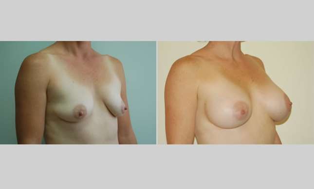 Breast Augmentation: Image #10