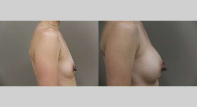 Breast Augmentation: Image #1011