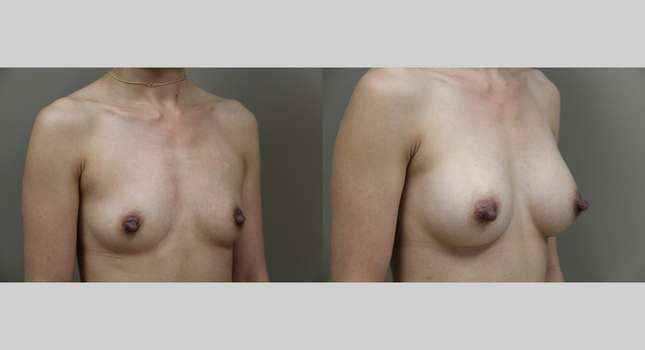 Breast Augmentation: Image #1012