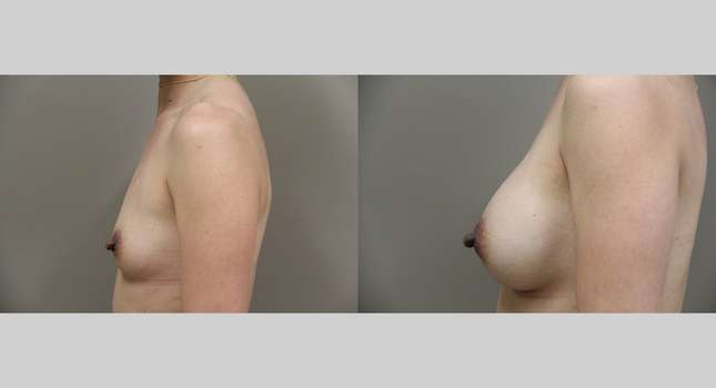 Breast Augmentation: Image #1013