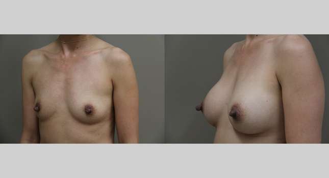 Breast Augmentation: Image #1014