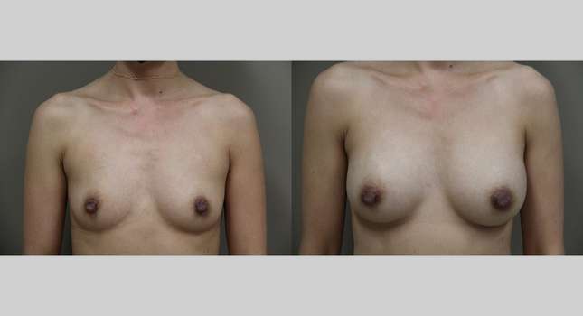 Breast Augmentation: Image #1015