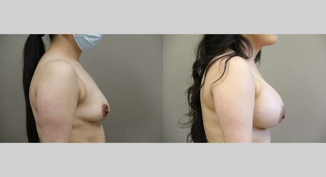 Breast Augmentation: Image #1016