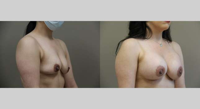 Breast Augmentation: Image #1017