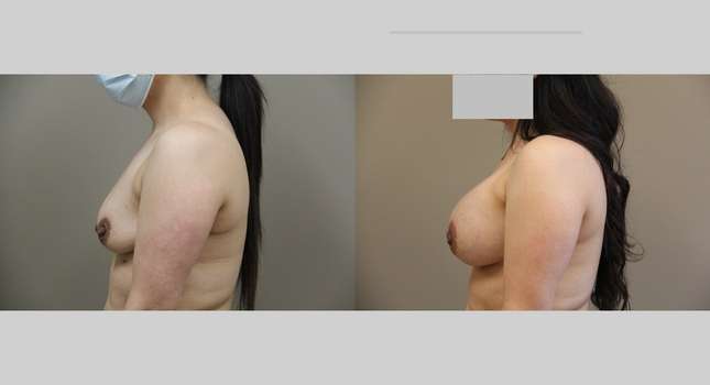 Breast Augmentation: Image #1018