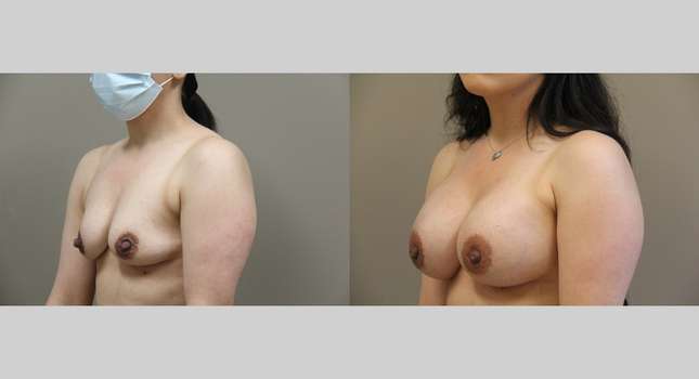 Breast Augmentation: Image #1019
