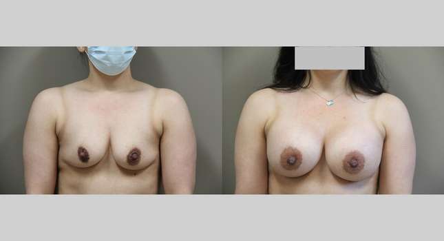 Breast Augmentation: Image #1020