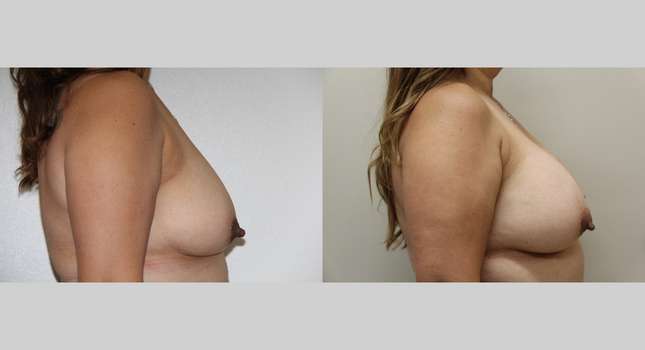 Breast Augmentation: Image #1021