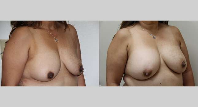 Breast Augmentation: Image #1022
