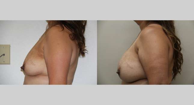 Breast Augmentation: Image #1023