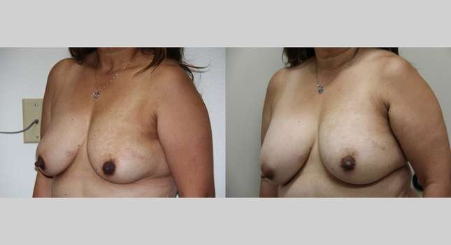 Breast Augmentation: Image #1024