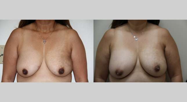 Breast Augmentation: Image #1025