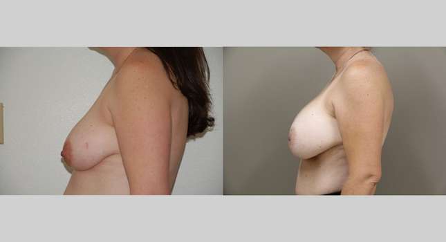 Breast Augmentation: Image #1047