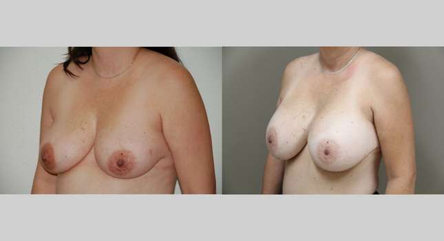 Breast Augmentation: Image #1048