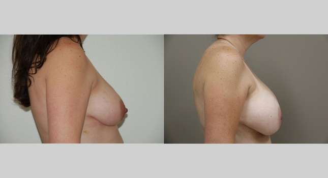 Breast Augmentation: Image #1049