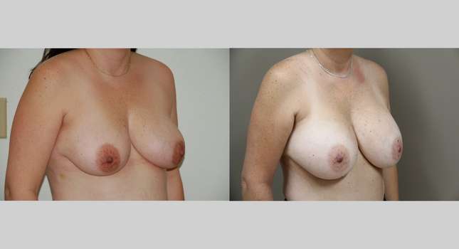 Breast Augmentation: Image #1050