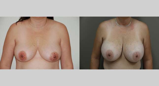 Breast Augmentation: Image #1051