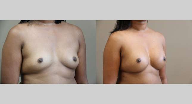 Breast Augmentation: Image #1053