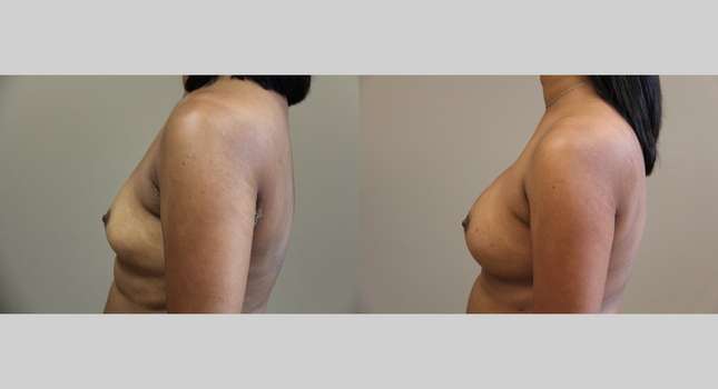 Breast Augmentation: Image #1054