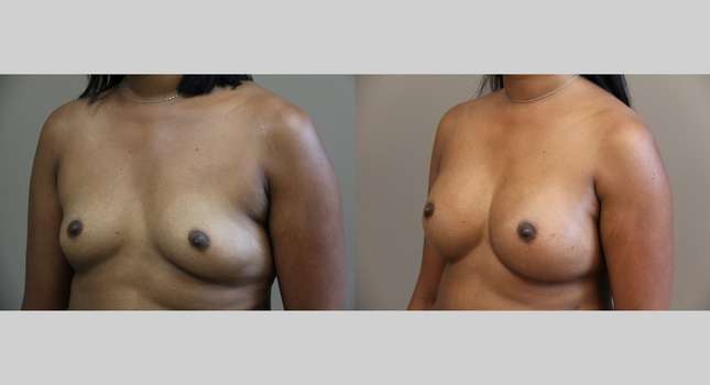 Breast Augmentation: Image #1055