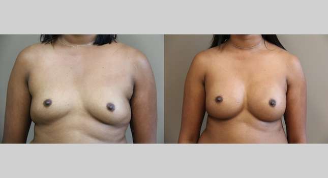 Breast Augmentation: Image #1056