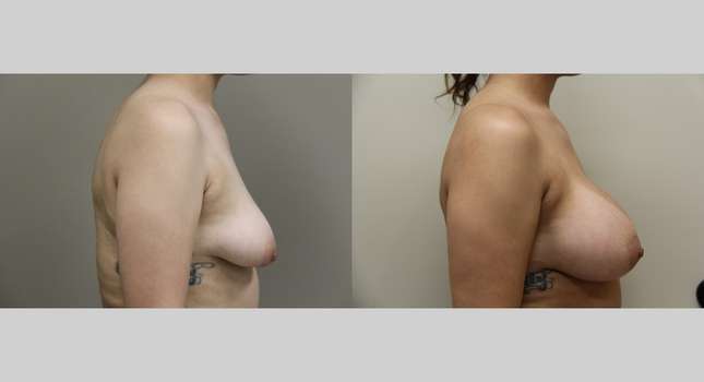 Breast Augmentation: Image #1061