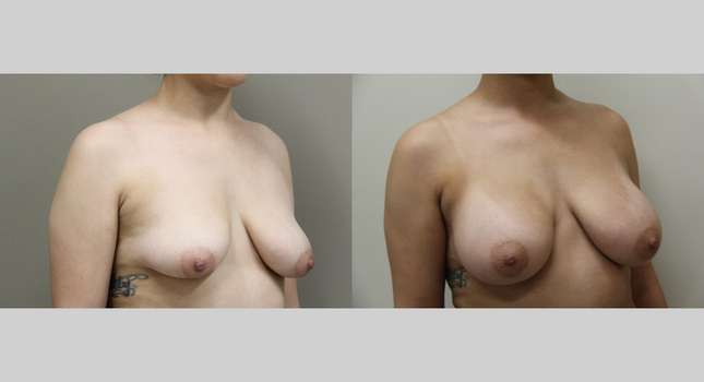 Breast Augmentation: Image #1062