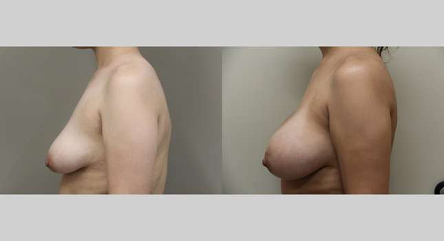 Breast Augmentation: Image #1063