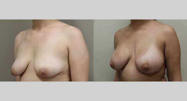 Breast Augmentation: Image #1064