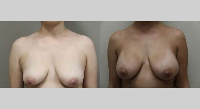 Breast Augmentation: Image #1065