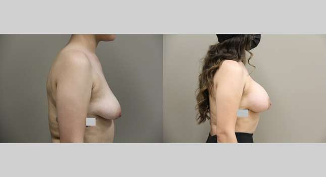 Breast Augmentation: Image #1066
