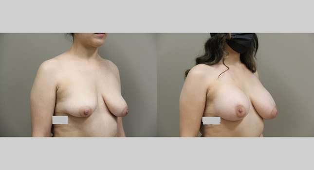 Breast Augmentation: Image #1067
