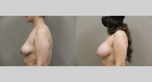 Breast Augmentation: Image #1068