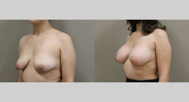 Breast Augmentation: Image #1069