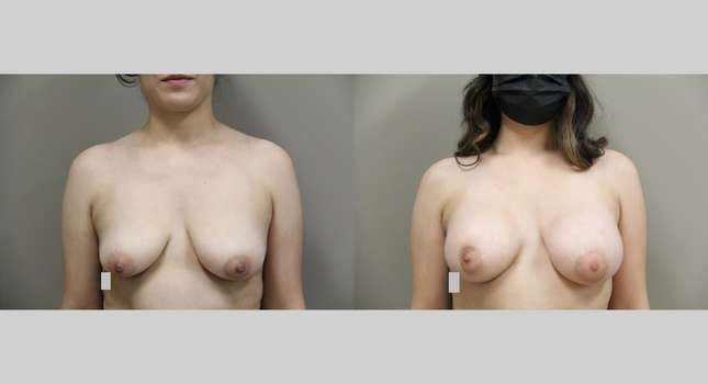 Breast Augmentation: Image #1070