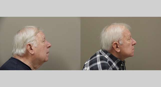 Facial Rejuvenation: Image #1094