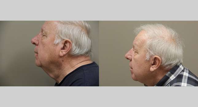 Facial Rejuvenation: Image #1096