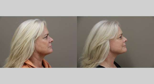 Facial Rejuvenation: Image #1099