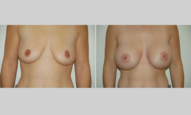Breast Augmentation: Image #11