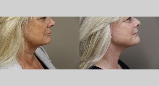 Facial Rejuvenation: Image #1100
