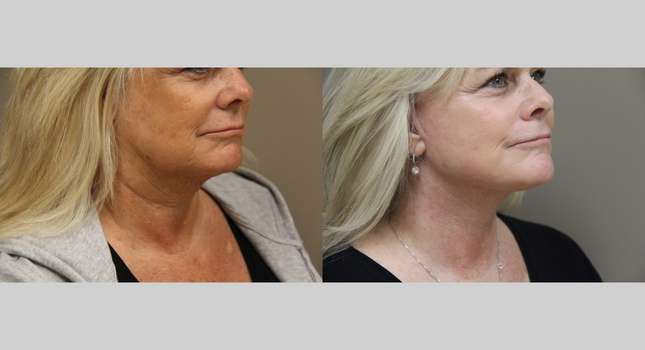 Facial Rejuvenation: Image #1102