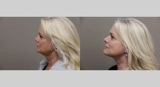 Facial Rejuvenation: Image #1103