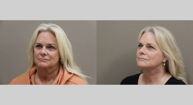 Facial Rejuvenation: Image #1104