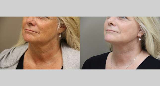 Facial Rejuvenation: Image #1105