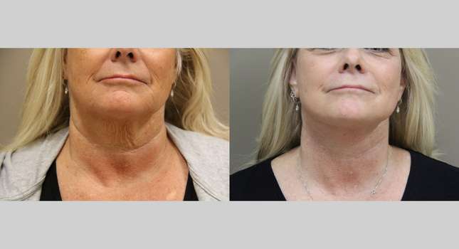 Facial Rejuvenation: Image #1106