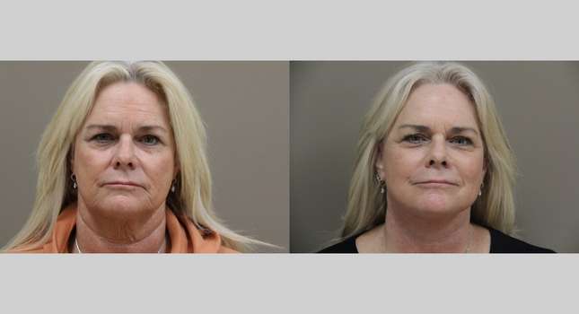 Facial Rejuvenation: Image #1107