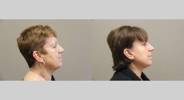 Facial Rejuvenation: Image #1115